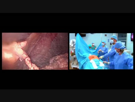 Operacja pierwotnej przepukliny pępkowej metodą laparoskopową IPOM