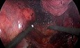 Laparoskopowa prawostronna adrenalektomia olbrzymiego guza nadnercza (14 cm)