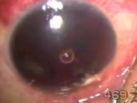 Pourazowy wylew krwi do oka - operacja z użyciem noża Fugo