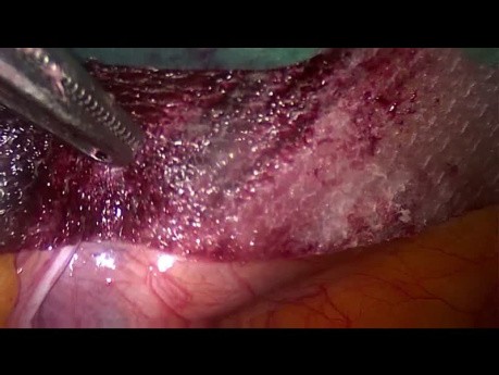Wewnątrzotrzewnowa implantacja nieporowatej siatki Ventralight-Glutack