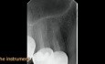 Endodoncja - usuwanie złamanego narzędzia