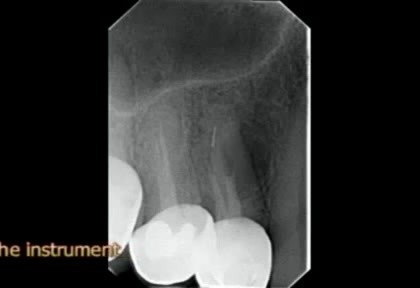 Endodoncja - usuwanie złamanego narzędzia