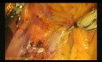 Laparoskopowa limfadenektomia z powodu raka prawej części okrężnicy