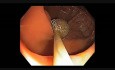 Kolonoskopia: jak przeprowadzić endoskopową resekcję śluzówkową - zmiana G