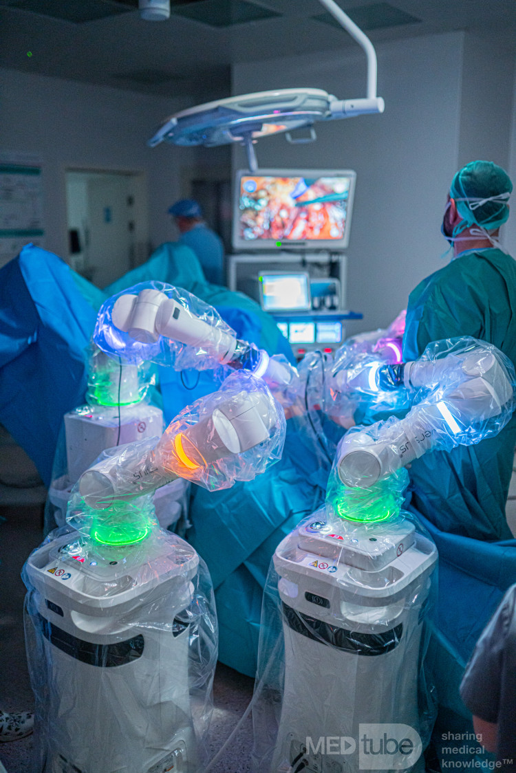Versius in Clinical Use in Urology at Salve Medica Medical Centre, Łódź - 3 BSU’s