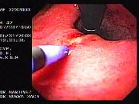 Żołądek klepsydrowaty - skurcz proksymalnej części trzonu żołądka - zespół Mallory-Weiss
