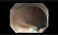 Kolonoskopia - EMR okrężnicy esowatej jako alternatywa dla operacji