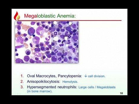 Hematologia czerwone krwinki - niedokrwistości niedoborowe