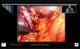 Postępowanie laparoskopowe w kamicy przewodowej