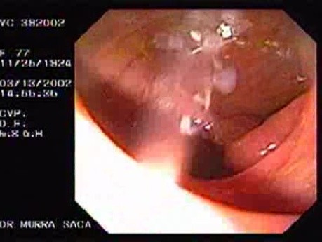 Gruczolakorak okrężnicy poprzecznej - endoskopia (2 z 9)