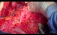 Operacja cytoredukcyjna raka jajnika. Wersja nieedytowana. Część II: środkowa część brzucha.