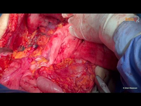 Operacja cytoredukcyjna raka jajnika. Wersja nieedytowana. Część II: środkowa część brzucha.