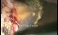 Cholecystektomia - metoda laparoskopowa