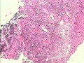 Drobnokomórkowy rak płuc naciekający górną i środkową część przełyku (7 z 7)