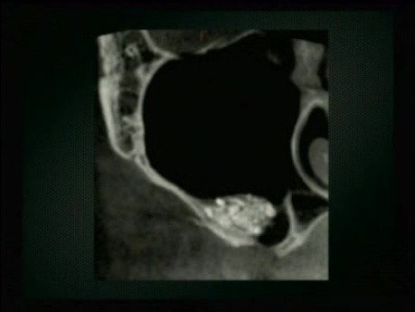 CBCT w analizie i planowaniu zabiegów chirurgiczno-implantologicznych - część 3