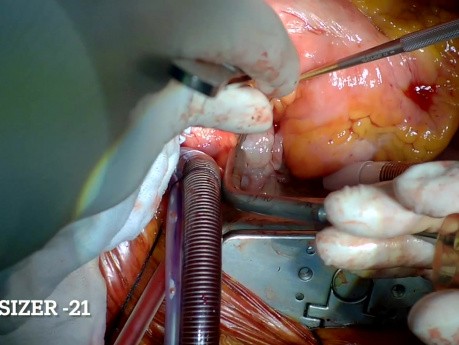 Wymiana zastawki aortalnej i mitralnej w przypadku infekcyjnego zapalenia wsierdzia 