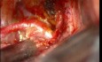 Klipsowanie tętniaka tętnicy łączącej przedniej mózgu - przypadek 3