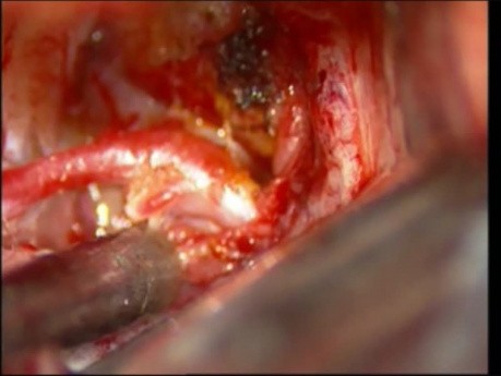 Klipsowanie tętniaka tętnicy łączącej przedniej mózgu - przypadek 3