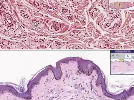 Żółtak - histopatologia skóry