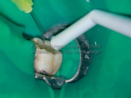 Endodoncja - leczenia kanałowe i-Race