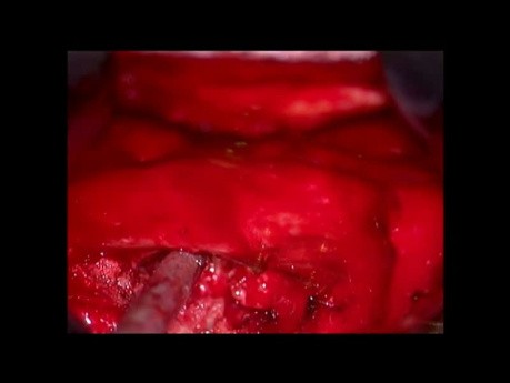Przepuklina krążka międzykręgowego w odcinku piersiowym
