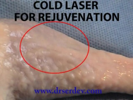 Laserowe ściąganie naskórka i odmładzanie skóry