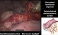 Ileocistoplastia laparoscópica asistida por robot y apendicovesicostomía de Mitrofanoff