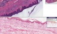 Naciek limfocytarny - histopatologia - skóra