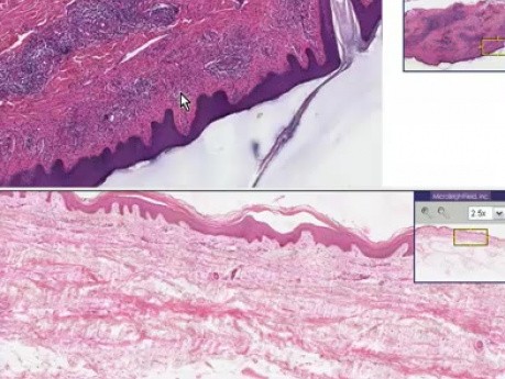 Naciek limfocytarny - histopatologia - skóra