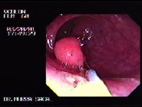 Endoskopowa polipektomia (1 z 2)