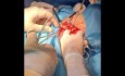 Cervicotomía exploradora por obstrucción de vía digestiva por cuerpo extrańo