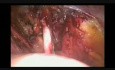Limfadenektomia miednicy - metoda laparoskopowa