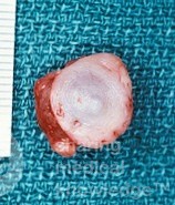 Torbiel śluzowa wargi (wycinek chirurgiczny)