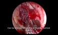  Endoskopowa operacja zatok w leczeniu przewlekłego zapalenia zatok z polipami nosa - podejście od przodu do tyłu