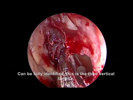 Endoskopowa operacja zatok w leczeniu przewlekłego zapalenia zatok z polipami nosa - podejście od przodu do tyłu