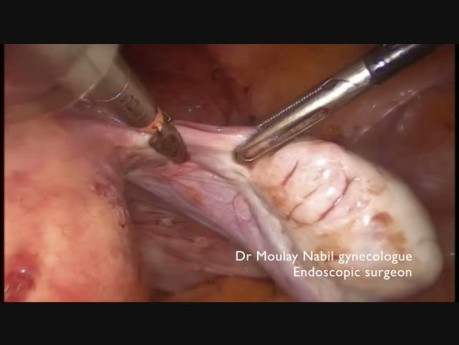 Całkowita histerektomia laparoskopowa z wewnątrzbrzuszną hemisekcją