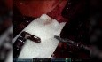 Technika chirurgiczna z zastosowaniem TachoSil® w chirurgii wątroby, trzustki i dróg żółciowych wspomaganej robotem w celu zapewnienia odpowiedniej hemostazy i uszczelnienia w lewostronnej hemihepatektomii