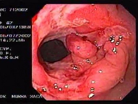 Choroba Leśniowskiego - Crohna - endoskopia (15 z 28)