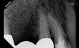 Ominięcie złamanego narzędzia endodontycznego