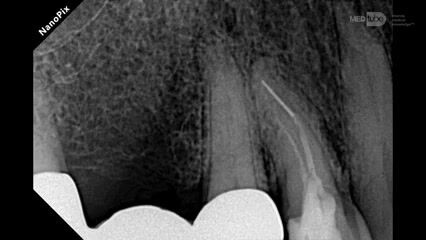 Ominięcie złamanego narzędzia endodontycznego