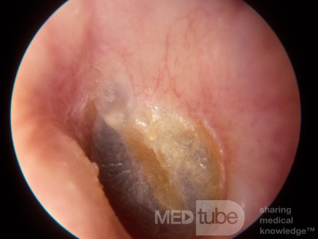 Przewlekłe błoniaste zapalenie ucha zewnętrznego (po oczyszczeniu)