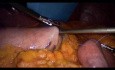 Operacja żołądka metodą Gastric bypass - część 1