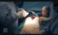 Konwersja przezcewnikowej implantacji zastawki aortalnej do wymiany klasycznej