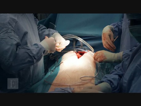 Konwersja przezcewnikowej implantacji zastawki aortalnej do wymiany klasycznej