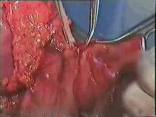 Operacja raka żołądka - subtotalna proksymalna gastrektomia
