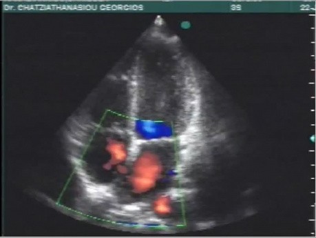 Kardiologiczny quiz 3 - pacjent z wrodzoną chorobą serca - EKG, ECHO