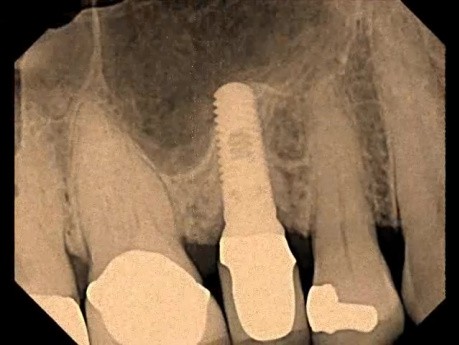 Trudny przypadek natychmiastowej implantacji