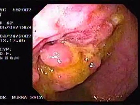 Choroba Leśniowskiego - Crohna - endoskopia (5 z 28)