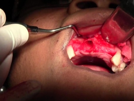 Ekstrakcja i chirurgiczne oczyszczenie rany (debridement) - Przeszczep kostny w szczęce - #7-8-10