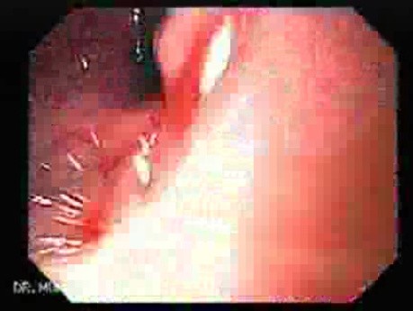 Przełyk Barretta i gruczolakorak połączenia żołądkowo-przełykowego - niechirurgiczne przywrócenie światła przełyku